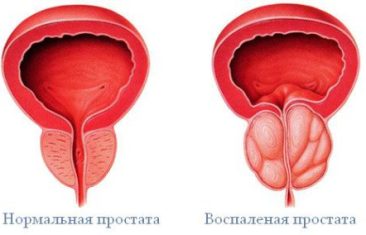 Что такое аденома простаты ?
